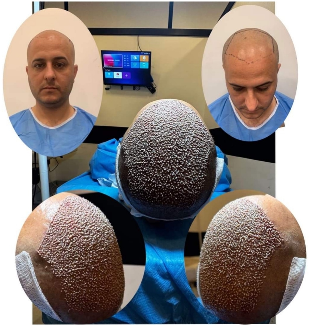 EstethicaP's tweet photo. رأيكم في كثافة الشعر 
ممتازة / جيدة / عادية
للآستعلام يرجى التواصل معنا ;  
https://t.co/aQtEGBHEgS 📲
#تركيا🇹🇷 #سوريا ❤ #مصر🇪🇬 #الامارات 🇦🇪 #اليمن🇾🇪 #العراق🇮🇶 #البحرين🇧🇭 #الكويت🇰🇼 #السعودية🇸🇦#قطر🇶🇦  #الاردن🇯🇴 #فلسطين🇵🇸 #السودان🇸🇩 #الجزائر🇩🇿 #تونس🇹🇳 #المغرب 🇲🇦 #ليبيا 🇱🇾 https://t.co/WhK5o501aD