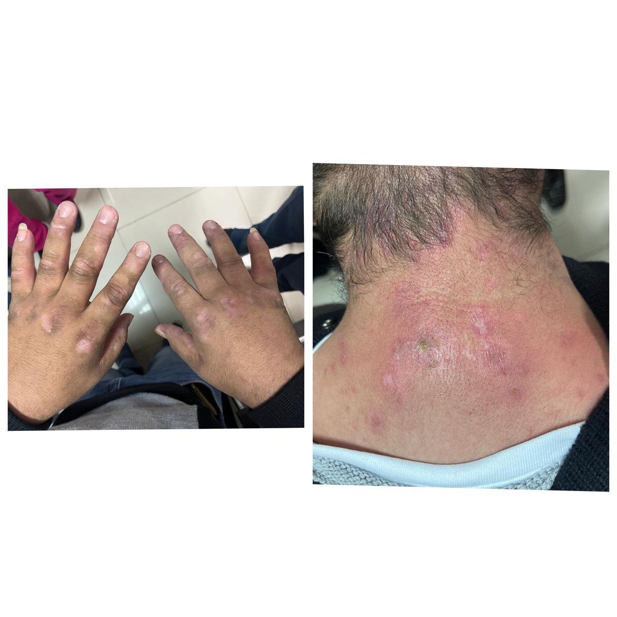La #dermatomiositis afecta #Piel y #músculo (#miopatía proximal, elevación de enzimas musculares). A nivel dérmico  se observa #heliotropo,#rashmalar, rash en parte posterior del cuello y región superior de espalda, pápulas de #Gottron como se ven en esta paciente con DMT. #cpk