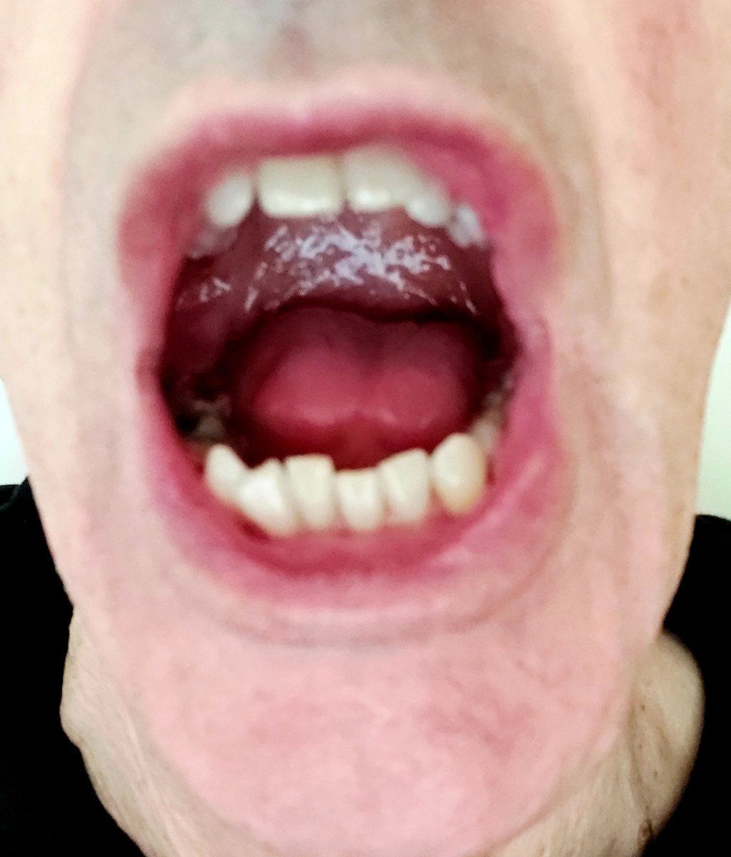 BeckGra's tweet photo. DENTIST: I'm going in without using anaesthetic. Is that alright?
ME: Ermm...Yes.
#dentist #toothfilling #painwhatpain #painless #dentistry #hull https://t.co/duogYHvg9x