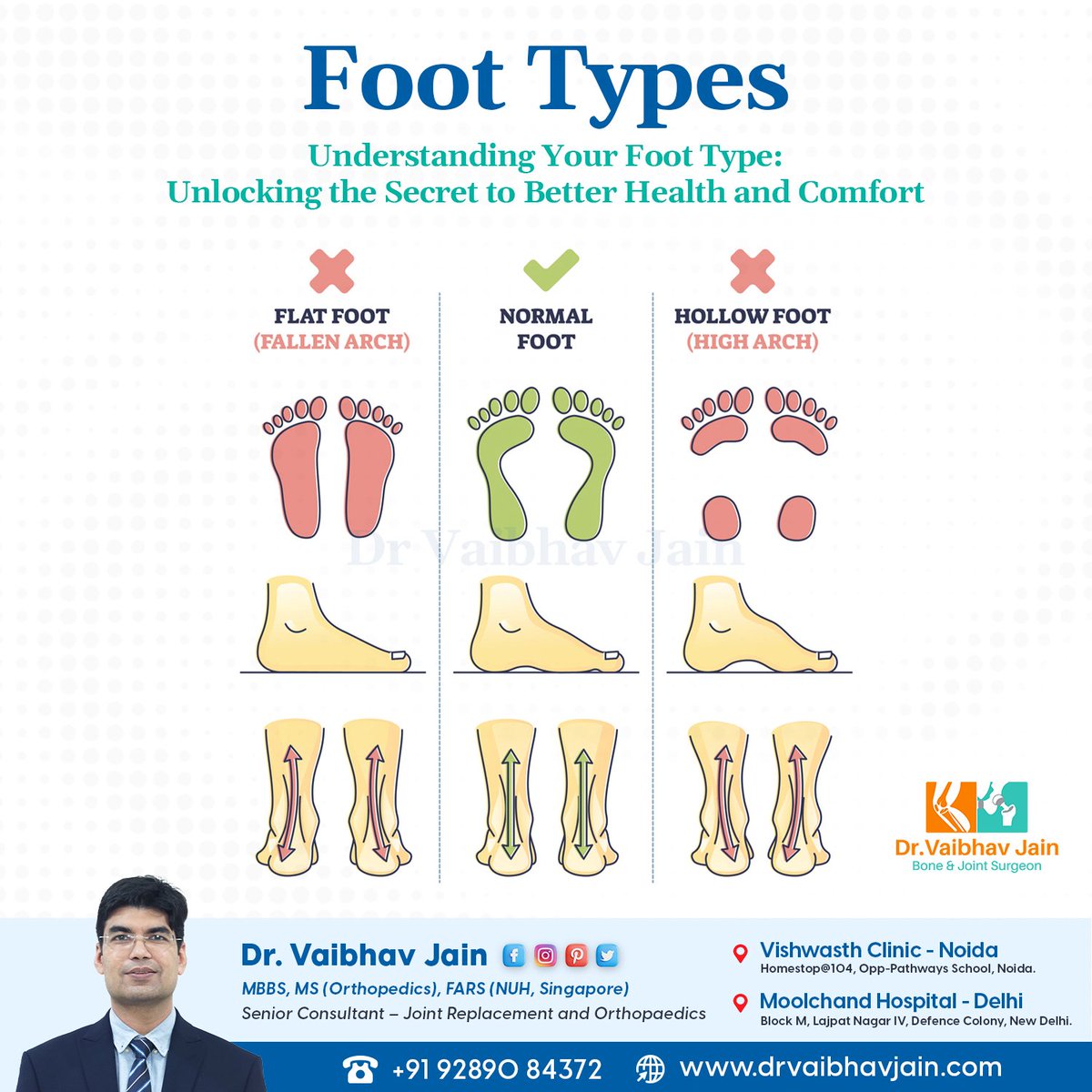 drvaibhavjain's tweet photo. Step into better health and comfort by understanding your foot type! Discover the secret to happy feet with our expert tips and advice.
☎️ +91 92890 84372
🌏 https://t.co/ltlxkUQTMN
#FootHealth #ComfortableFeet #FootType #BetterHealth #ExpertAdvice https://t.co/93uaH0McdI