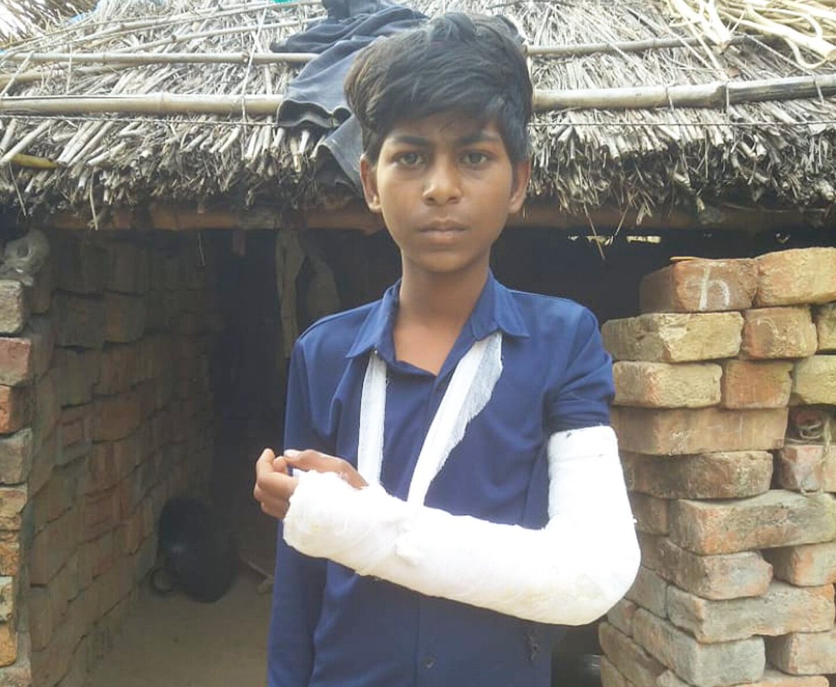 ambedkariteIND's tweet image. #Casteism Vikas Gautam, A class 6th Dalit student was brutally thrashed and broke Hands by his caste Hindu teacher Sanjay Singh in a primary school in Mariahu, Jaunpur. #UttarPradesh