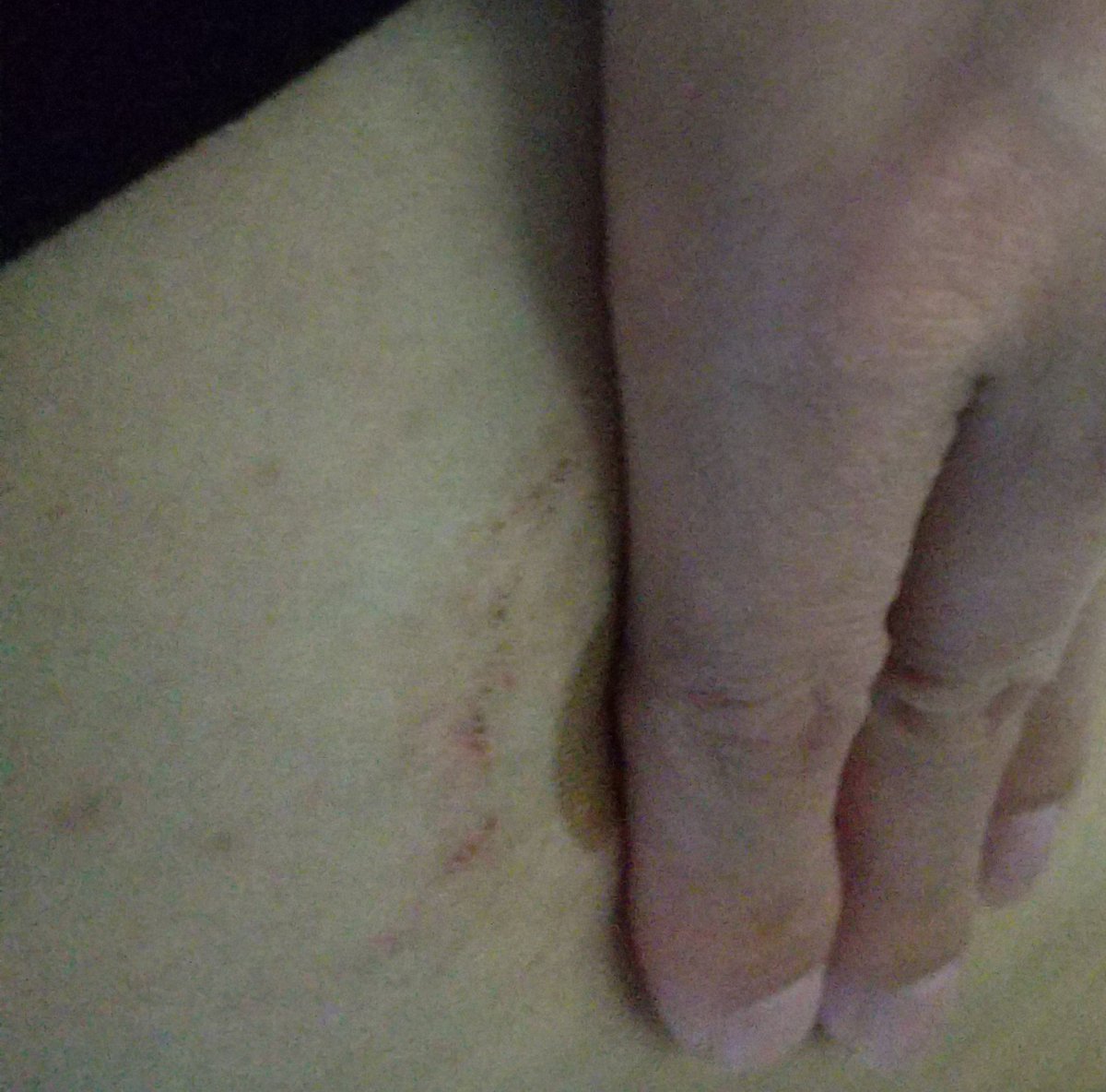 NozomiN9999's tweet image. nipple周りの傷の一部。ニップレス代わりはバンドエイド。荒れに荒れたので、奇行集団が故意につけた傷が主。

#集団ストーカー 
#ElectromagneticWave