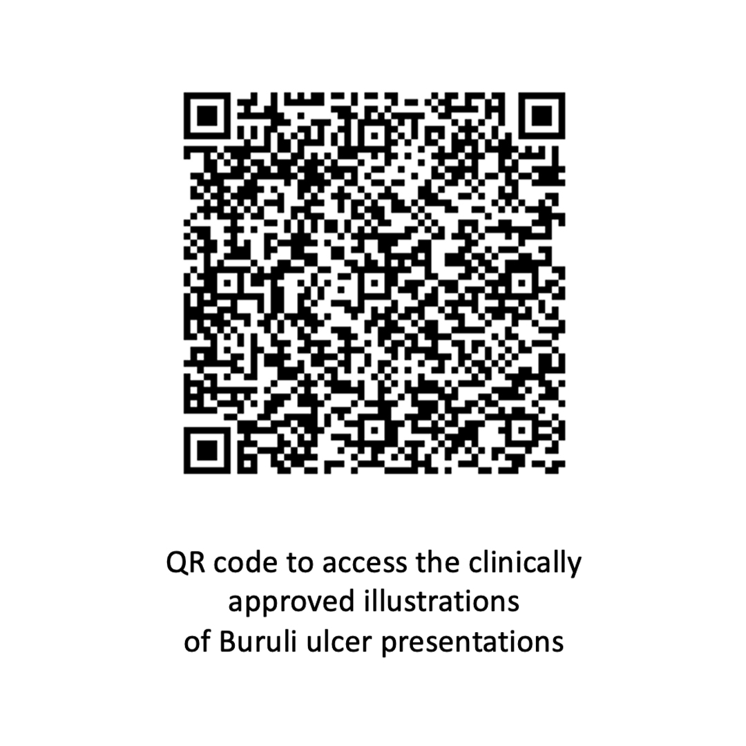 joannaculley's tweet photo. Use the QR code to access clinically approved medical illustrations of Buruli ulcer which have been published as part of a PhD study. These are available under a Creative Commons license, (free to use and intended for health education).

#skinNTDs #ntds #medicalartists https://t.co/DQZoWmE6Oe
