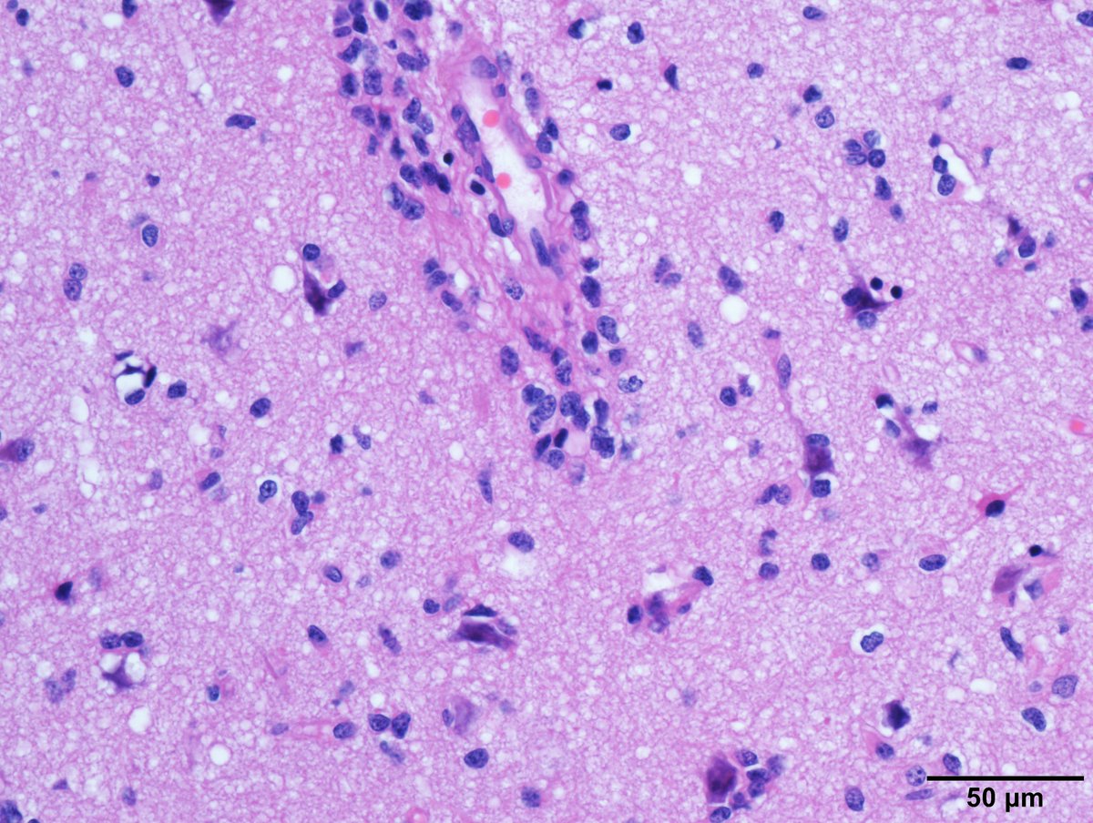 11y. Female. Frontal lobe.