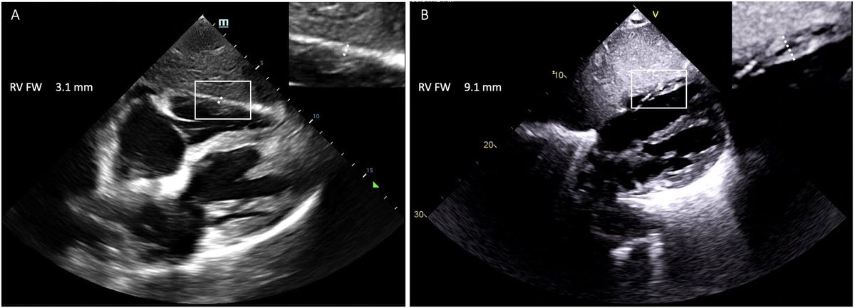 RutgersPOCUS's tweet photo. RV hypertrophy suggests chronic RV dysfunction - best assessed from zoom-in SX view.
Chronic dysfunction:
1Qual: RV free wall appears as thick as LV posterior wall (assuming not thinned out by prior MI), and has muscular trabeculations.
2Quant: RV free wall thickness > 5 mm https://t.co/xsKw0chjHw