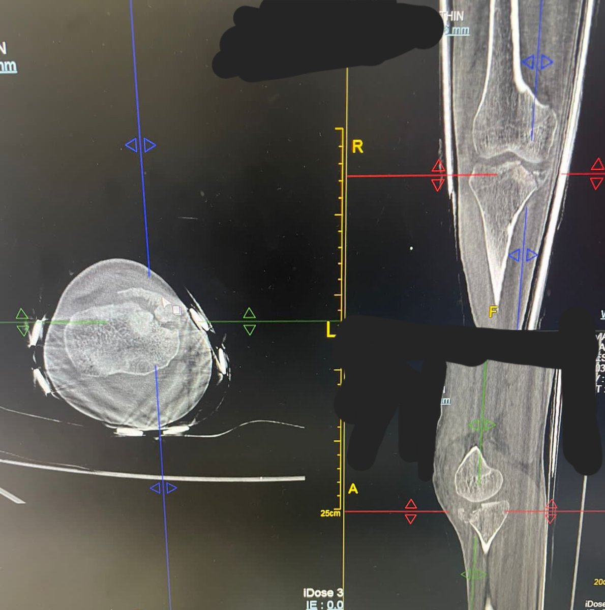 BoneJointDoctor's tweet photo. #orthotwitter
#orthobullets
@traumaticum
Adult male , hyperextension injury
Did medial Submeniscal arthrotomy to asses reduction. Bone substitutes to fill defect and used opposite side raft plate..
What literature says about this infrequent injury🙋♂️ https://t.co/GoAunMOp7O