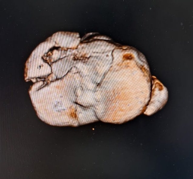 BoneJointDoctor's tweet photo. #orthotwitter
#orthobullets
@traumaticum
Adult male , hyperextension injury
Did medial Submeniscal arthrotomy to asses reduction. Bone substitutes to fill defect and used opposite side raft plate..
What literature says about this infrequent injury🙋♂️ https://t.co/GoAunMOp7O