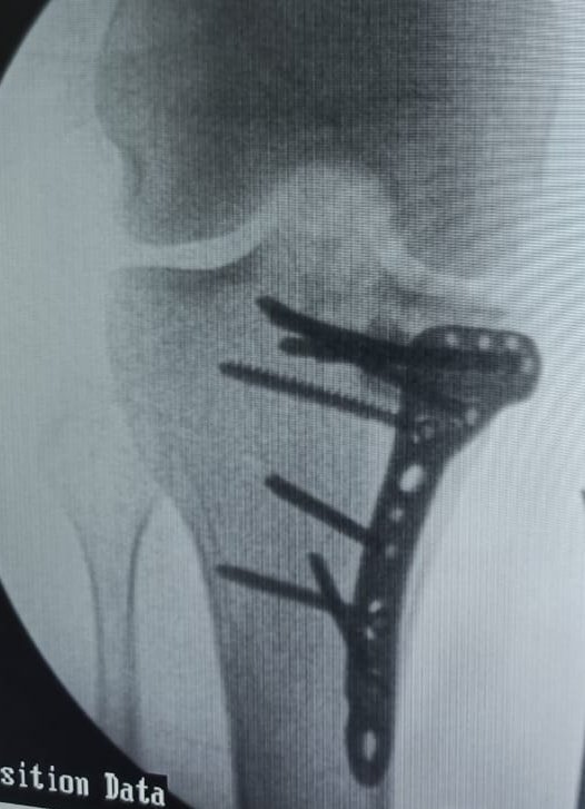 BoneJointDoctor's tweet photo. #orthotwitter
#orthobullets
@traumaticum
Adult male , hyperextension injury
Did medial Submeniscal arthrotomy to asses reduction. Bone substitutes to fill defect and used opposite side raft plate..
What literature says about this infrequent injury🙋♂️ https://t.co/GoAunMOp7O