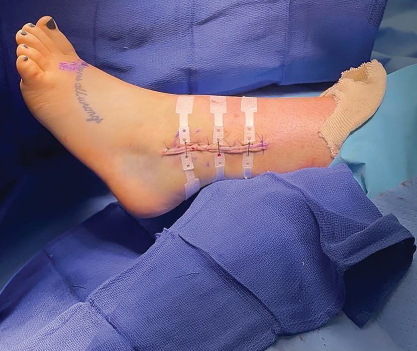 Closing surgical sites properly and managing incisions post-discharge are the critical final steps of satisfactory surgeries. bit.ly/40Dxx5L