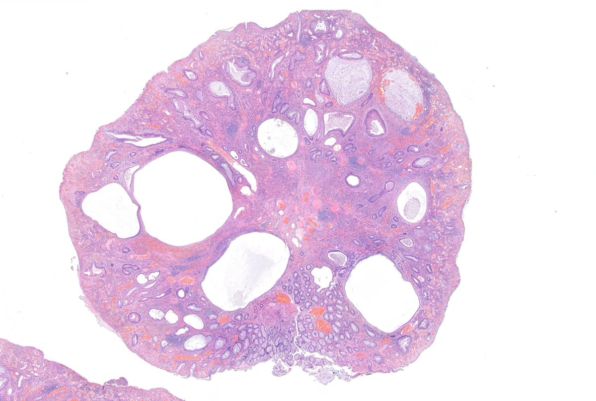 zucchiatti_'s tweet photo. Juvenile (retention) polyp. #GIpath
Most common type of pediatric intestinal polyp
Prominent, cystically dilated glands and inflammatory stroma
Juvenile refers to the type of polyp (hamartomatous), not the age of presentation! https://t.co/uj05GRxJGb