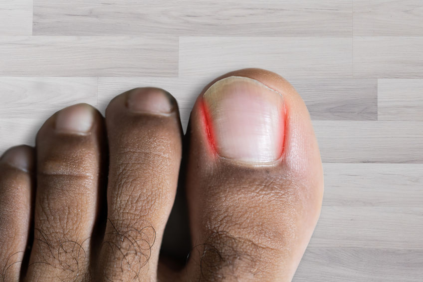 CaringPodiatry's tweet photo. Ingrown toenails can be hereditary or a result of improper trimming/footwear. With time, they can become increasingly painful &amp; even lead to an infection, which can subsequently spread through the bone structure of the foot. Good news! We got you covered! https://t.co/VwAWKniktt https://t.co/BOpALIZvIf