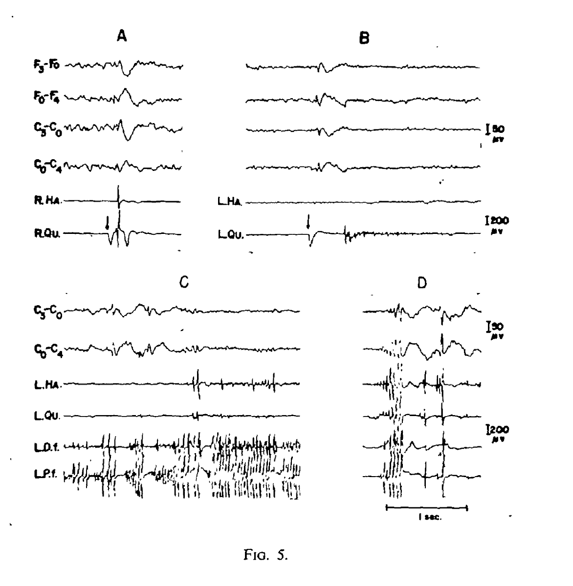 SEIZURE SEMIOLOGY TWEETORIAL Epilepsy Seizure Neurotwitter 🧵/1 What