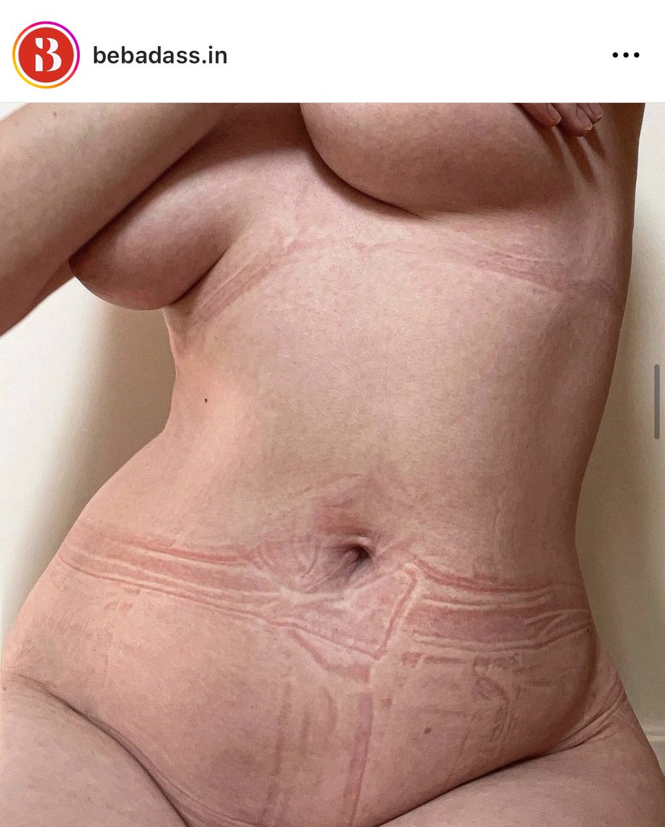 totomathon's tweet photo. Instagram post by @BeBadassDotIn about unrealistic beauty standards urging women to put themselves through discomfort in everyday clothes.
Photo credit: @TheCharliHoward
#UnrealisticBeautyStandards
#BodyPositive
#BeKindToYourBody https://t.co/5mFQci5XVj