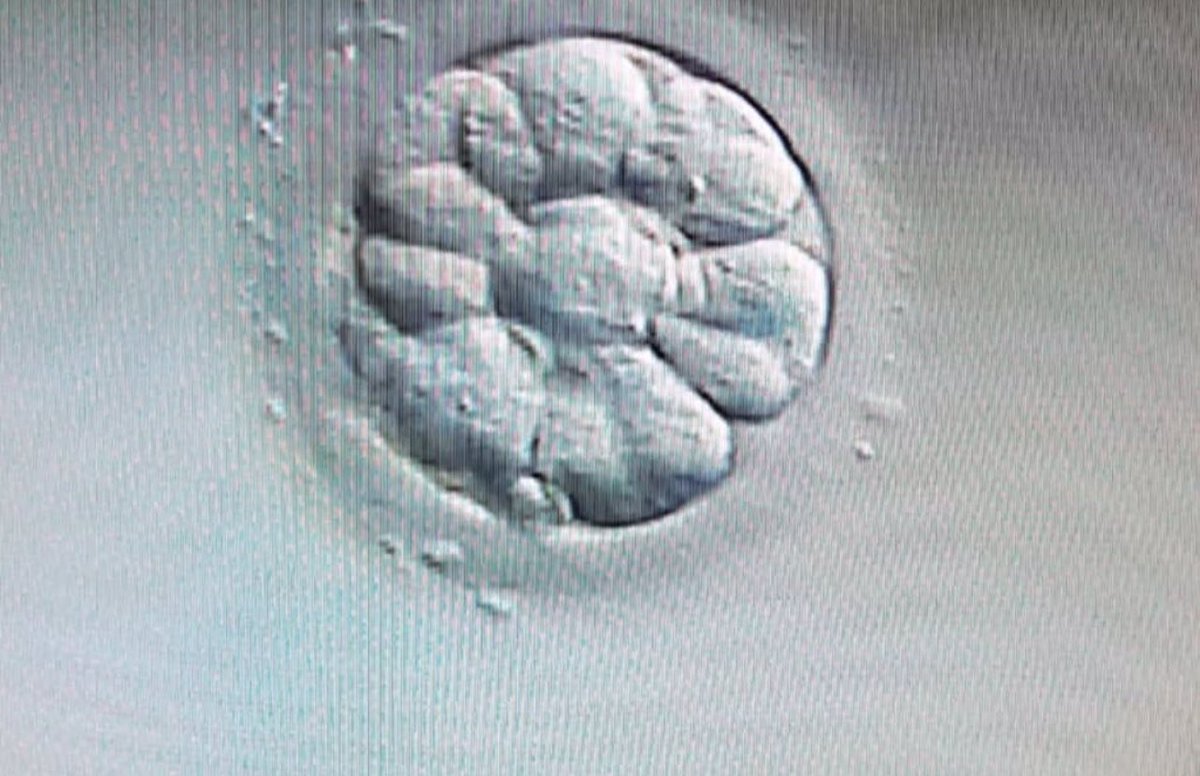 dr_pariissa's tweet photo. Morula Embryo Flowerlike
The morula stage is the final stage prior to formation of a fluid filled cavity called the blastocoel cavity
#Morula #Embryo #Flower #MedTwitter https://t.co/cmY5jTkTbH