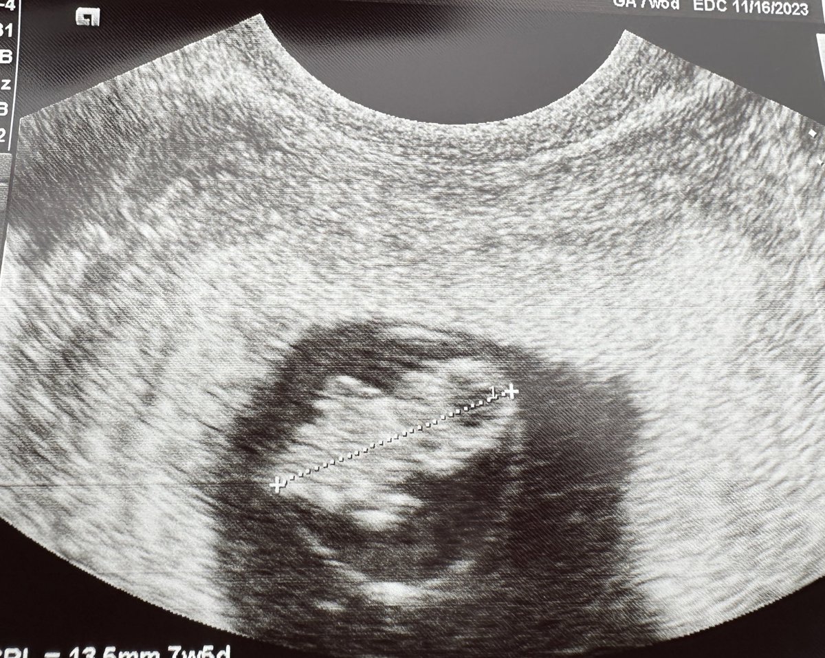 My little blueberry has a heartbeat and things just got really real🥹🤍
