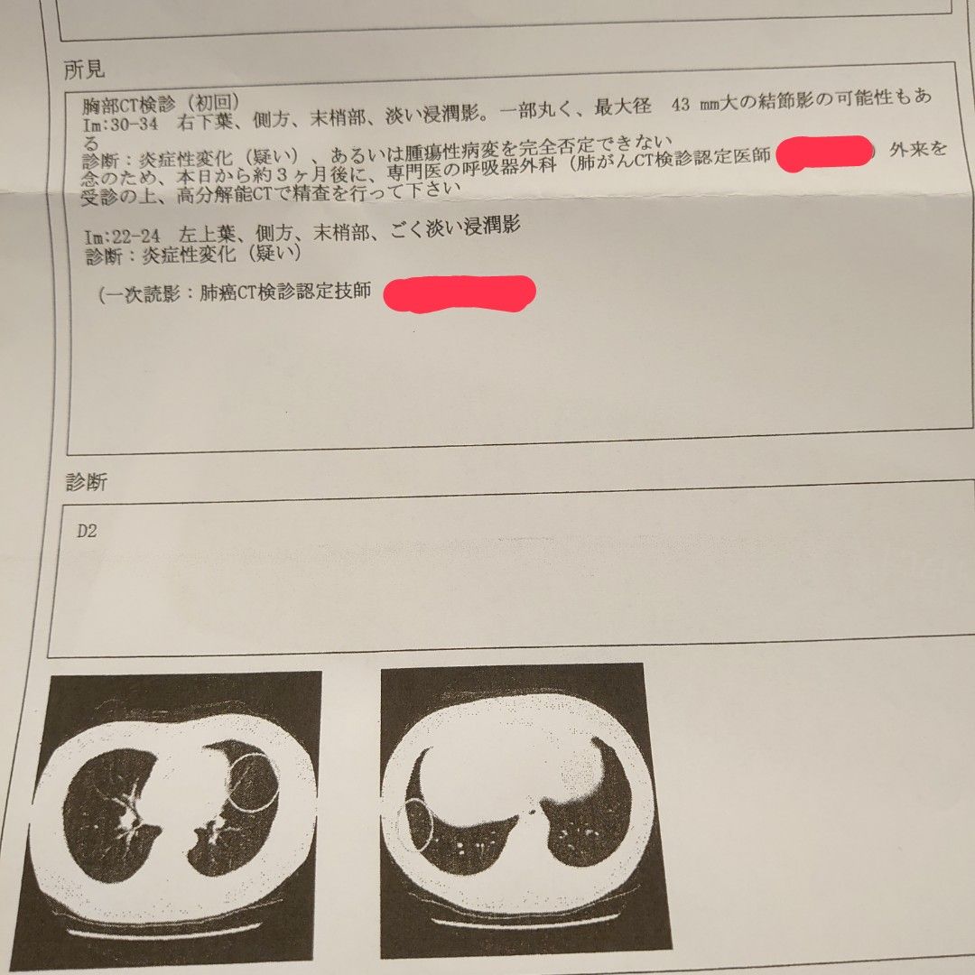 人間ドックの肺がんctでやばそうな結果が来てしまった
精密検査まであと1ヶ月くらい
結果が早く知りたいわー
ネット検索すると43ミリは大きいのでかなりヤバそうな雰囲気がする(泣)
詳しい方いたら教えて下さい