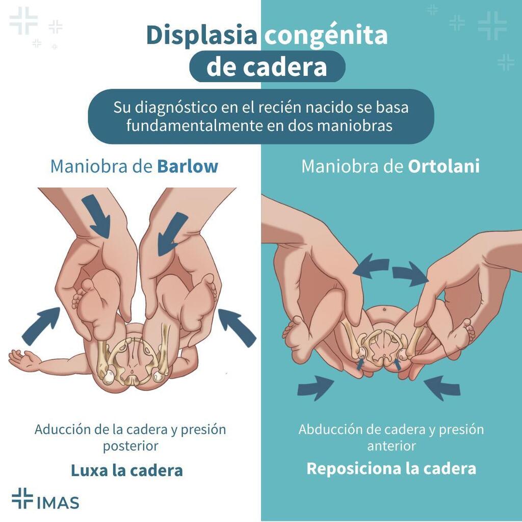 CursosImas's tweet photo. 📚Displasia congénita de cadera

Su diagnóstico en el recién nacido se basa fundamentalmente en dos maniobras que valoran la reductibilidad o la luxabilidad de la cadera del neonato:

📌Maniobra de Ortolani: consiste en la abducción de la cadera desde … https://t.co/MjdGHaCbzn https://t.co/OS0sQfakra