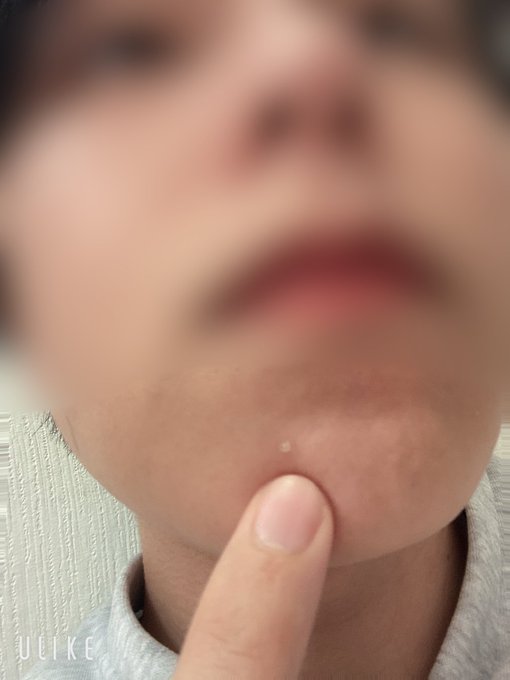 クソデカにきびできた https://t.co/jnkSMFlyfn<a href="/tag/gay"class="tags"><span>#gay</span></a><a href="/tag/%E3%82%B2%E3%82%A4"class="tags"><span>#ゲイ</span></a><a href="/tag/%E3%83%90%E3%82%A4"class="tags"><span>#バイ</span></a>