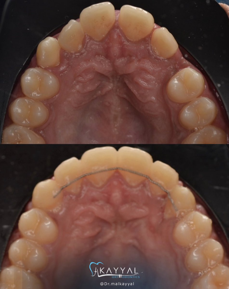 كان عنده ناب مدفون وخرجناه الحمد لله
.
عيده السنة بأنياب كاملة 😍😉 🌙
.
#ladenta_consultants_dental_clinic #لادنتا #ladenta_dental_office  #عيادات_لادنتا_الاستشارية_لطب_الأسنان
