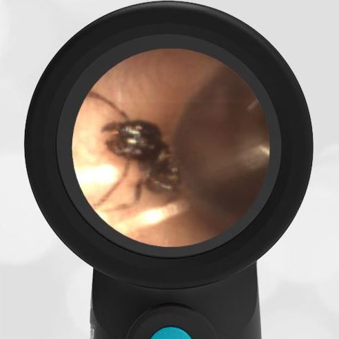 WiscMedWispr's tweet photo. Do you feel a tickle in your ear?

A 12-year-old male complains of something tickling his ear. The following image is obtained. https://t.co/WlBjLmA5Rn