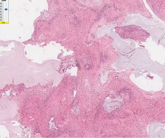 Ovary - Frozen section diagnosis series
Appendiceal neoplasm metastatic to ovary
-Bland, hypermucinous look
-Diffusely dissecting mucin
Dr. Djordjevic ISGyP Feb2023
#everydayGYN #gynpath #PathTwitter #pathologists #Pathresident #pathfellow #frozensections