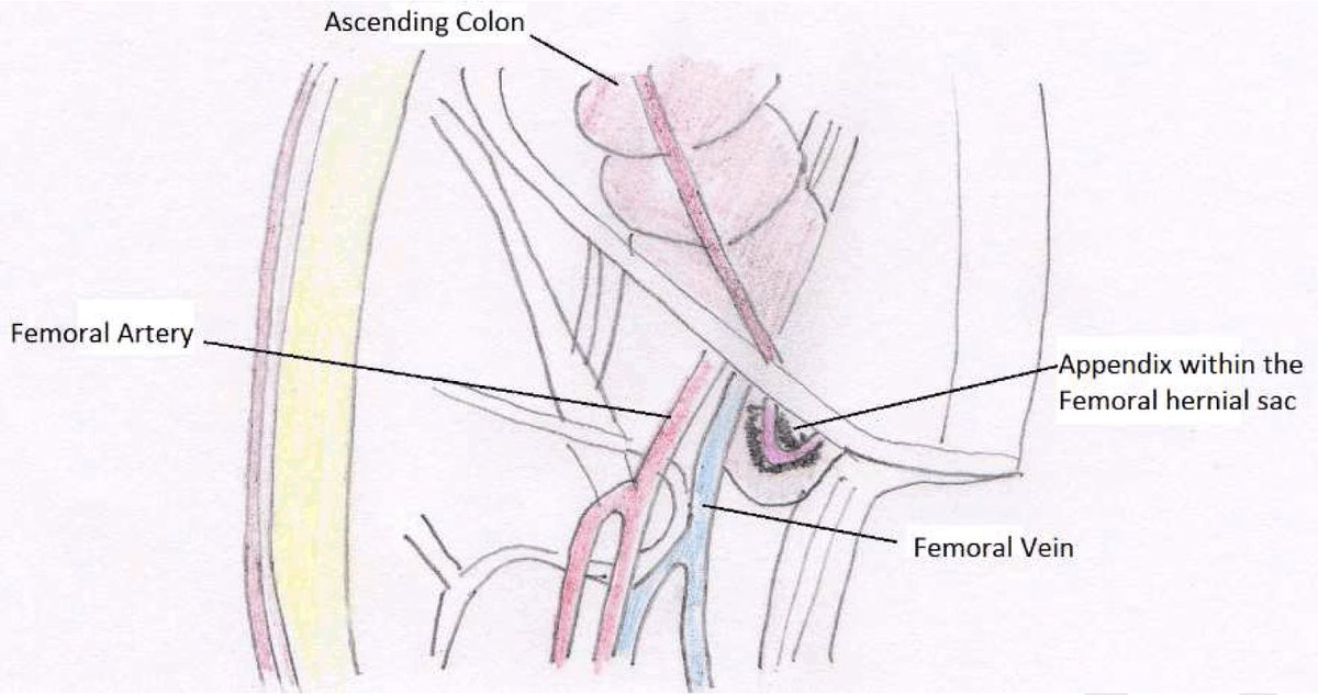 CiruAndes2's tweet photo. Amyand hernia: vermiform appendix with or without acute appendicitis inside of a indirect groin hernia 🆚 Garengeot hernia: vermiform appendix with or without acute appendicitis inside of an femoral groin hernia ✂️🔊🪢! #SoMe4Surgery @pferrada1 @PipeCabreraV @SWexner @juliomayol https://t.co/i2YPrn3d51