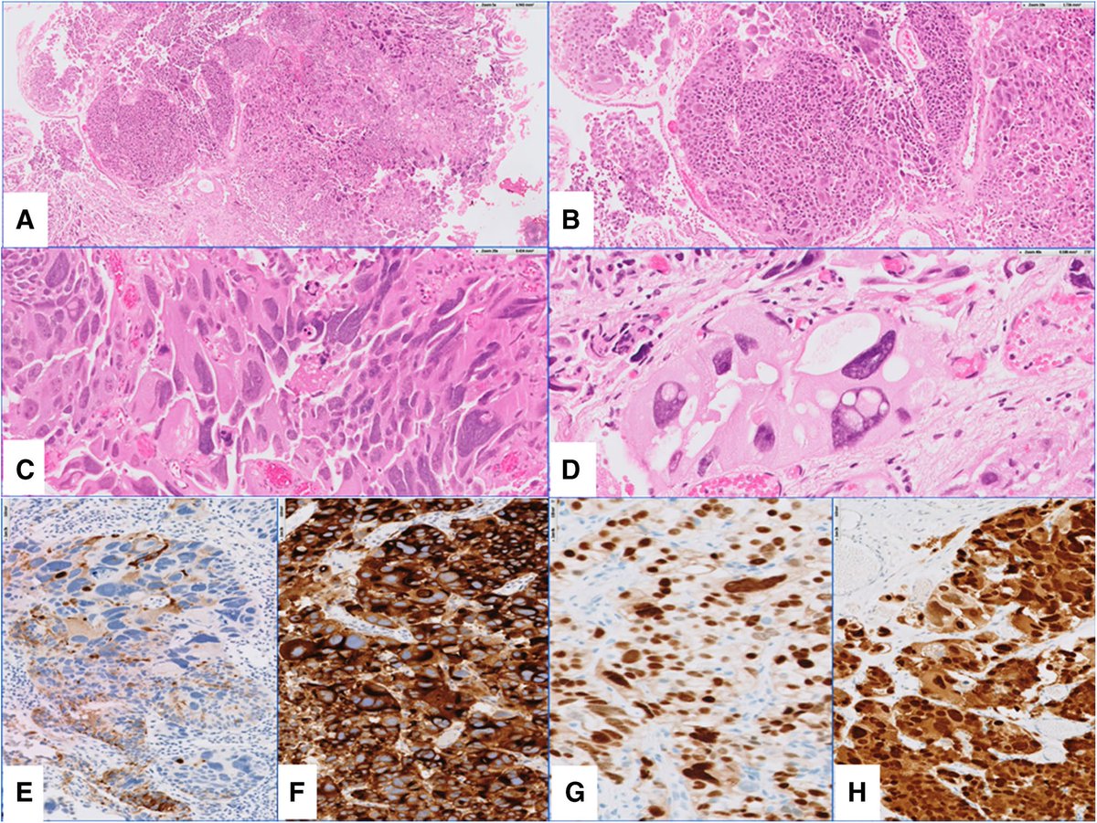 LiangChengMD's tweet photo. Big Congratulations to Andrela, Prof. Lopez Belteran's team for the appearance of this amazing paper in March Issue of Virchows Archiv @ESP_Pathology 
Pleomorphic giant cell carcinoma of the prostate https://t.co/1d3PNTw6QV 
https://t.co/NWUz1scvQP https://t.co/utxHUtav4W
