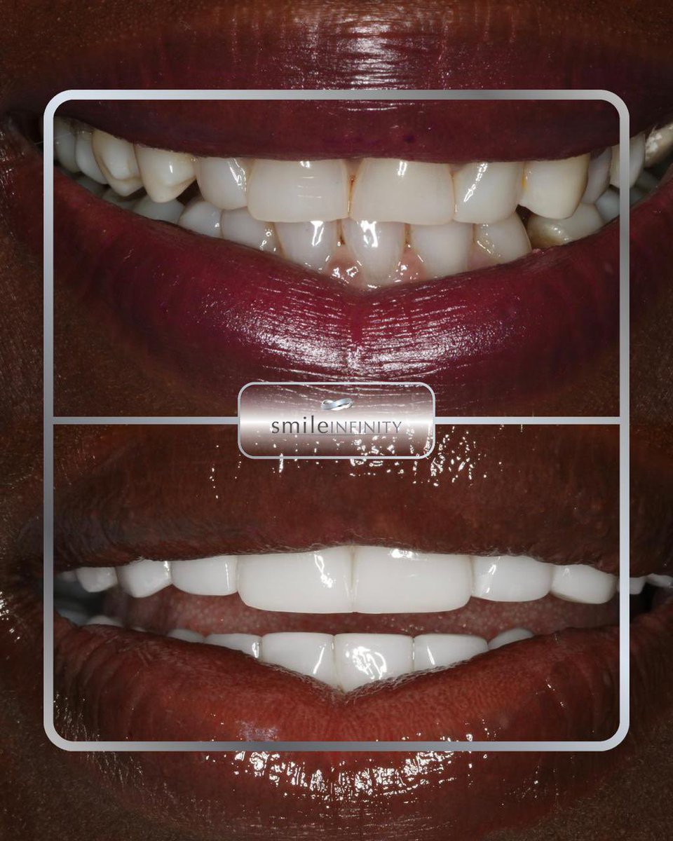 habibzarifeh's tweet photo. Creating beautiful smiles all over the world ! #smiles #hollywoodsmile #smileinfinity #habibzarifeh https://t.co/Gb60wweBxf
