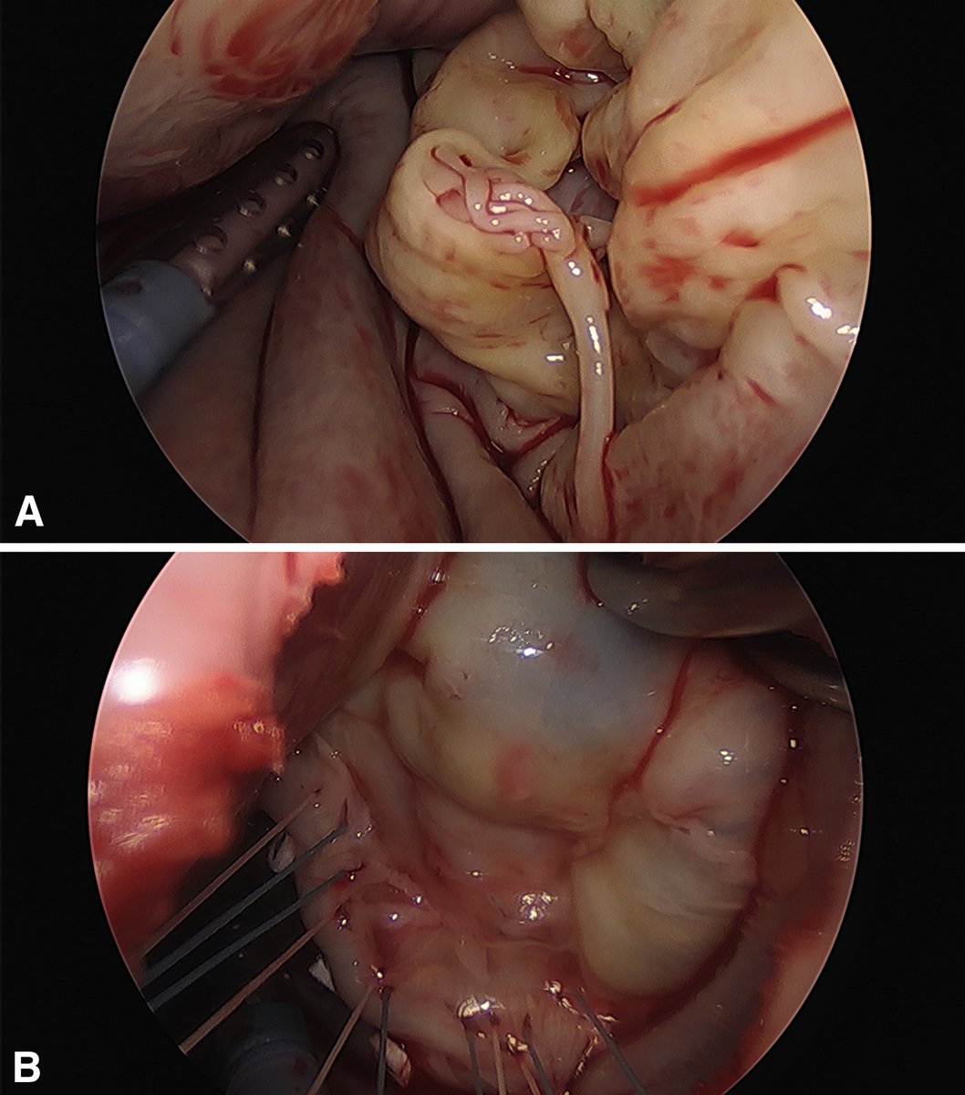 AATSJournals's tweet photo. Mitral valve repair using the peeling, endarterectomy, and decortication technique for debulking thick leaflets. Read the JTCVS Techniques article by @jairaman24, Kumar, et al: https://t.co/lipsxf9Q7P 

@AATSHQ @tssmn #MitralValve #MitralSurgery https://t.co/3gaNXLwgvy
