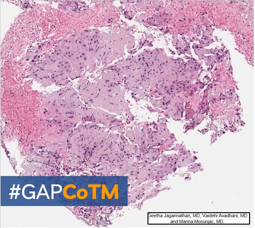GAPathologists's tweet photo. CoTM: 68yo female with stable pulmonary nodules, and elevated ACE presented with new onset fatigue, back pain, and weight loss. Labs revealed abnormal LFTs.  MRI showed heterogeneous enhancement of liver parenchyma.

By: Drs. Jagannathan, Avadhani and Mosunjac https://t.co/ATl67wunuH