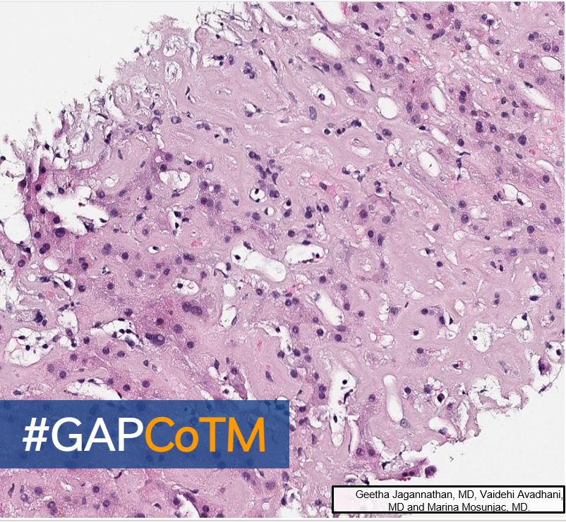 GAPathologists's tweet photo. CoTM: 68yo female with stable pulmonary nodules, and elevated ACE presented with new onset fatigue, back pain, and weight loss. Labs revealed abnormal LFTs.  MRI showed heterogeneous enhancement of liver parenchyma.

By: Drs. Jagannathan, Avadhani and Mosunjac https://t.co/ATl67wunuH
