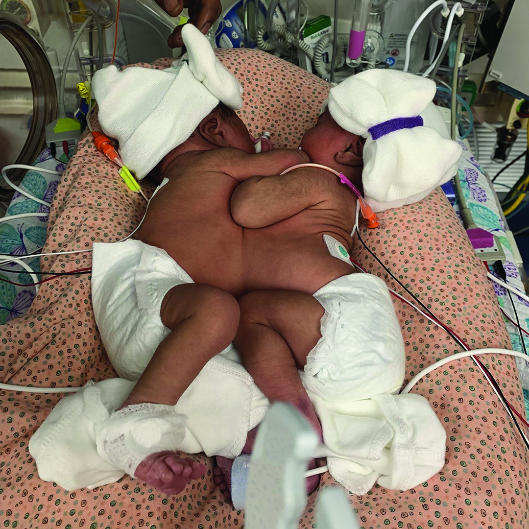 ASA Monitor (@ASAMonitor) on Twitter photo 2023-03-29 22:45:11 Meet the #anesthesiologists involved in the historical #ConjoinedTwin separation surgery at @CookChildrens. ow.ly/wMt350Nvljr #Anesthesiologists #Surgery #Twins #MedTwitter Meet the #anesthesiologists involved in the historical #ConjoinedTwin separation surgery at @CookChildrens. ow.ly/wMt350Nvljr #Anesthesiologists #Surgery #Twins #MedTwitter