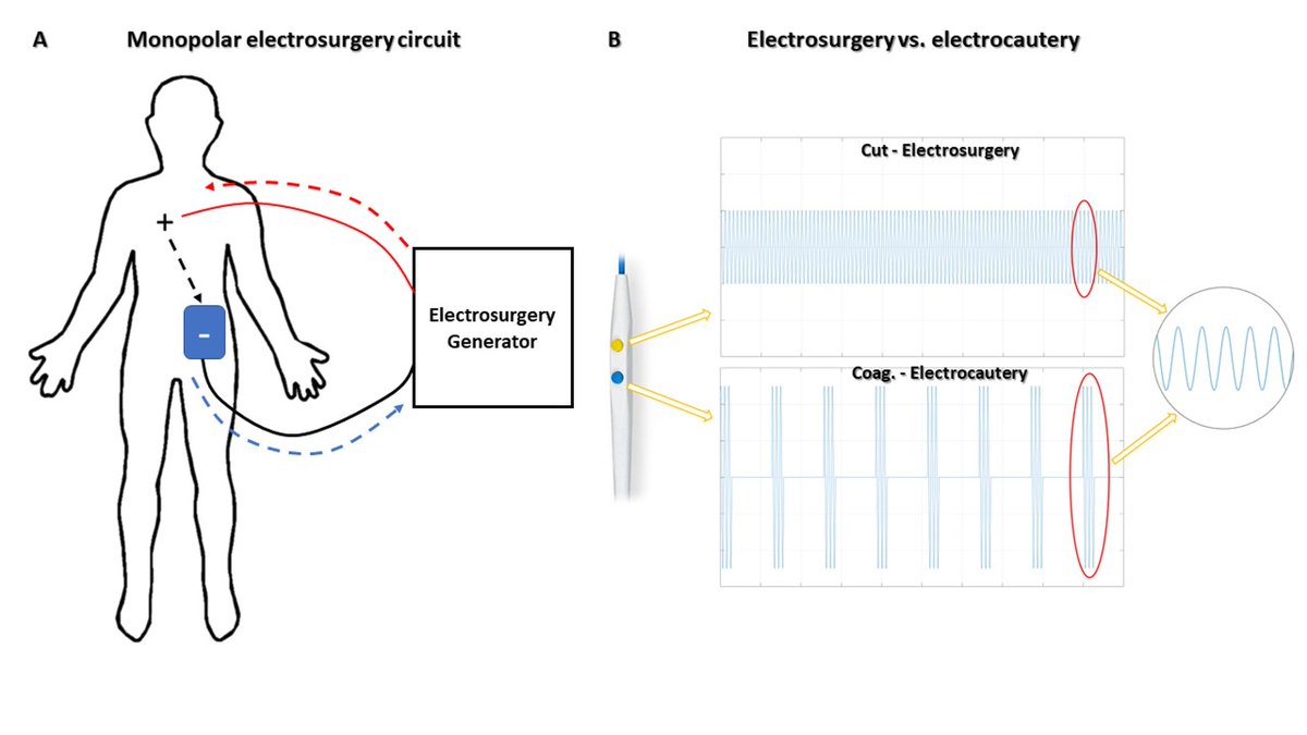 CircInterventions (@circintv) on Twitter photo Transcatheter Electrosurgery: Contemporary Review in Interventional Cardiology. @TheBethesdaLabs <a href="/ChrisGBruce13/">Chris Bruce</a> <a href="/CathElectroSurg/">Jaffar Khan</a> <a href="/AdamGreenbaumMD/">Adam Greenbaum</a> #cardiotwitter #ACCFIT #AHAJournals ahajrnls.org/40FK3lg Transcatheter Electrosurgery: Contemporary Review in Interventional Cardiology. @TheBethesdaLabs <a href="/ChrisGBruce13/">Chris Bruce</a> <a href="/CathElectroSurg/">Jaffar Khan</a> <a href="/AdamGreenbaumMD/">Adam Greenbaum</a> #cardiotwitter #ACCFIT #AHAJournals ahajrnls.org/40FK3lg