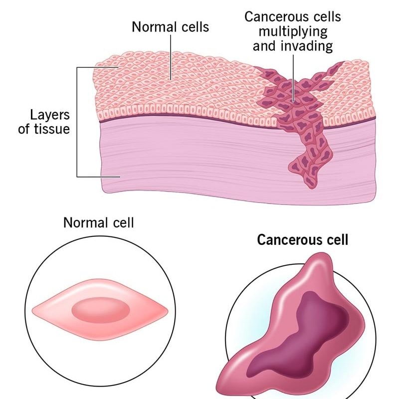 GazafJ's tweet photo. what are the common cancer types you know and which is deadliest ?
#dr_jibril
#cancerawareness
#we_are_learning
NB : image from Cleveland clinic https://t.co/wYbzS95vm6