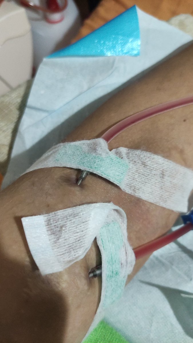 8 yıldır diyalize giriyorum ve böbrek nakli bekliyorum. Lütfen herkes organ bağışı yapsın  . Bizi sadece başına gelenler anlamasın. #demetOzdemir #batman #SılaTürkoğlu #TOGG #Erzurum