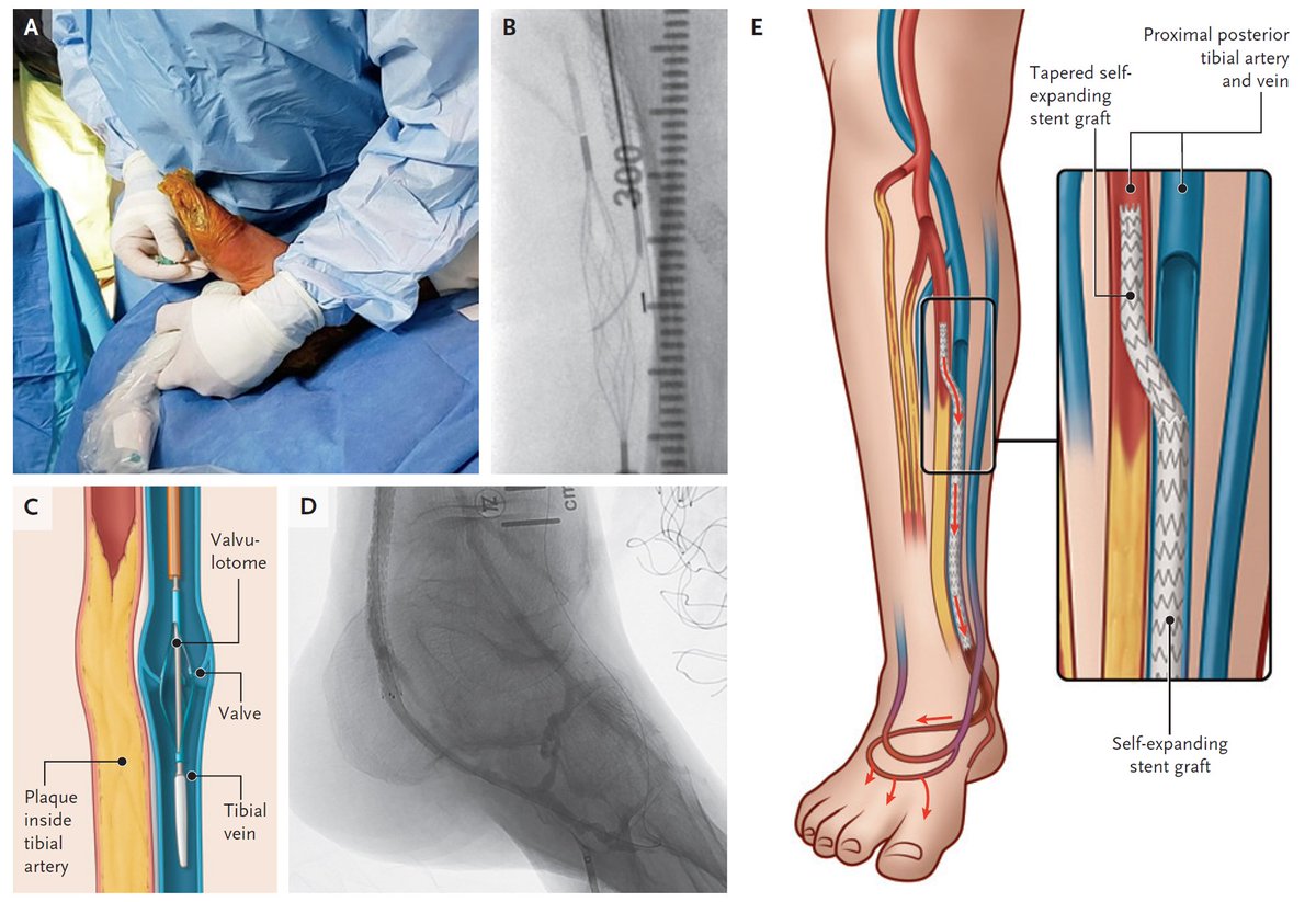Transcatheter arterialization of deep veins resulted in 6-month amputation-free survival in 66.1% of 105 patients with chronic limb-threatening ischemia and no conventional options for treatment. Full results of PROMISE II study: nej.md/3KbRNpS

#cardiology