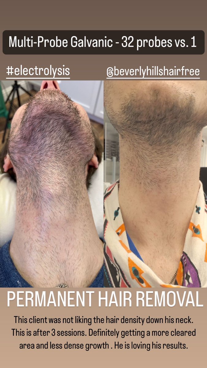 ryanvandyke's tweet photo. This client is loving his results after 3 sessions of multi probe galvanic #electroylsis @BHHairFree CONTACT US FOR YOUR PERMANENT HAIR REMOVAL NEEDS. Let’s get you on a treatment plan TODAY. https://t.co/piC20Ae0ih