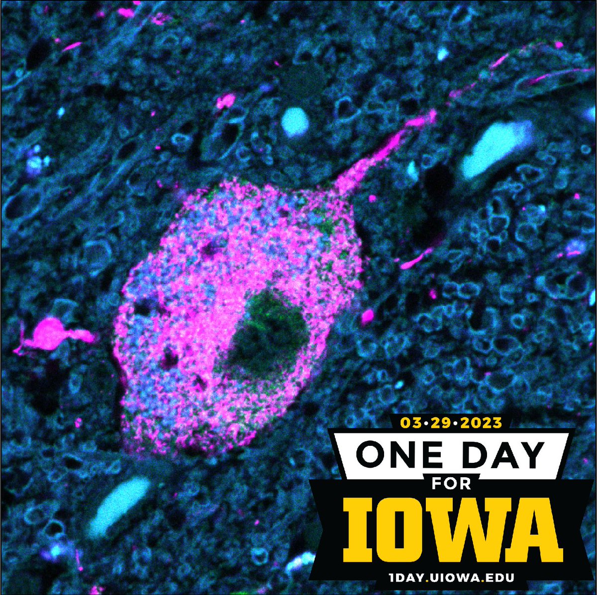 Your gift on #1DayforIowa helps fund research into Lewy body and Parkinson's dementia in the Aldridge Lab! givetoiowa.org/lewy Here you see pathological aggregates of a-synuclein (pink) filling a neuron in a person with severe dementia.