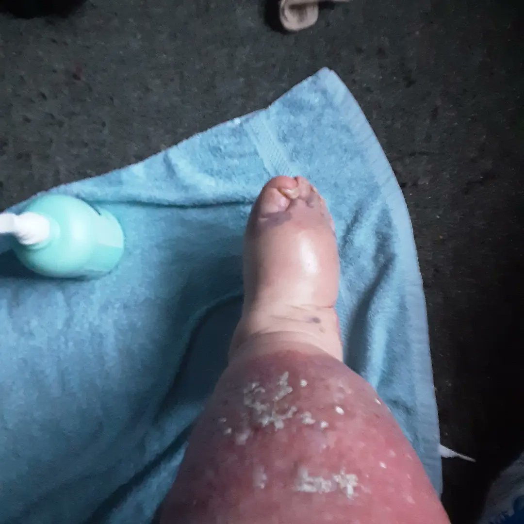 WarphobblerKaz's tweet image. The state of me (post weekend fall)...

(My shins are always this inflamed, &amp;amp; are also swollen, but this is much worsened post weekend trauma.) 

#COVIDLife #SeverelyIllAndDisabled #housebound #injured #fall #swelling #bruising #ouch

@RslewisSally @nysuri @DrJaninaRamirez