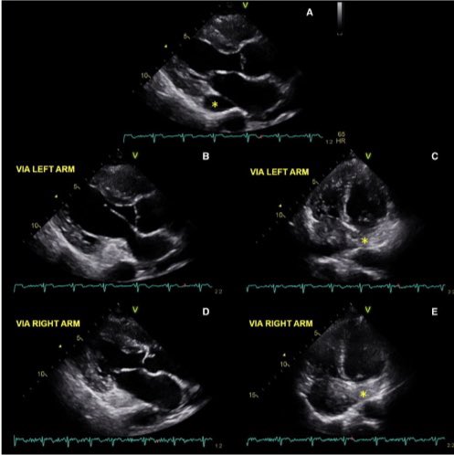 cardiopedhnn's tweet photo. @AntonioBarros_ @iamritu @VLSorrellImages @echo_stepbystep @pattypellikka @hahn_rt @JGrapsa @alexsfelixecho What I see is that the RA is opacified from flow through the dilated coronary sinus. Since the injection was done in the R-arm, I would suspect that there is absent #RSVC (isoleted #LSVC)
https://t.co/jlk9wuB1HL
#echofirst #CHD https://t.co/W75ArXubAu