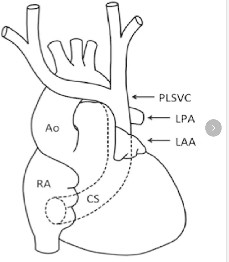 cardiopedhnn's tweet photo. @AntonioBarros_ @iamritu @VLSorrellImages @echo_stepbystep @pattypellikka @hahn_rt @JGrapsa @alexsfelixecho What I see is that the RA is opacified from flow through the dilated coronary sinus. Since the injection was done in the R-arm, I would suspect that there is absent #RSVC (isoleted #LSVC)
https://t.co/jlk9wuB1HL
#echofirst #CHD https://t.co/W75ArXubAu