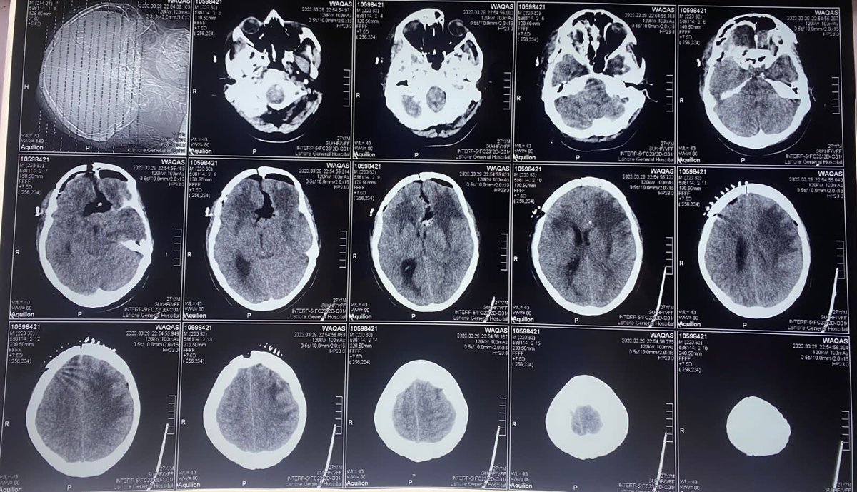 Huge Olfactory Groove Meningioma was Excised completely, identified & saved both carotids & ACAs. Alhamdolillah post op Patient is fully conscious (GCS=15/15) with no neurological deficit. 
#Neurosurgery #BrainSurgery #BrainTumours