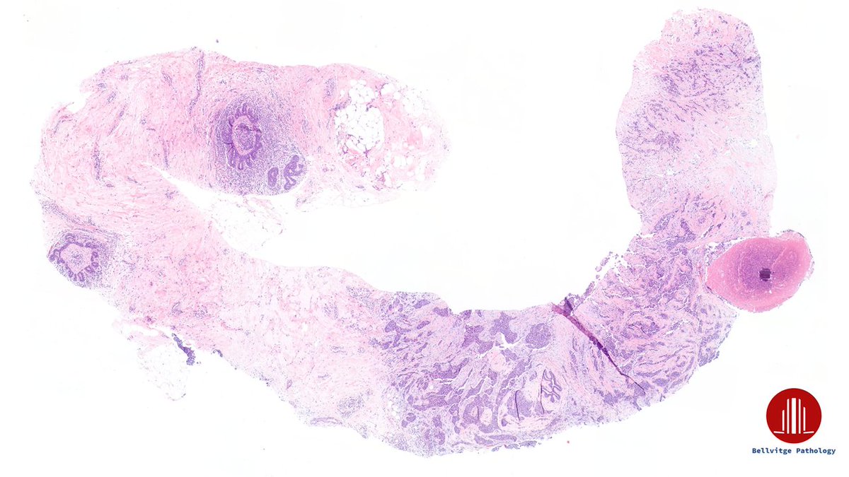 bellvitgepath's tweet image. Woman in her 50s. 
Left breast lesion, BI-RADS 4c.

#BreastPath #BellvitgePath