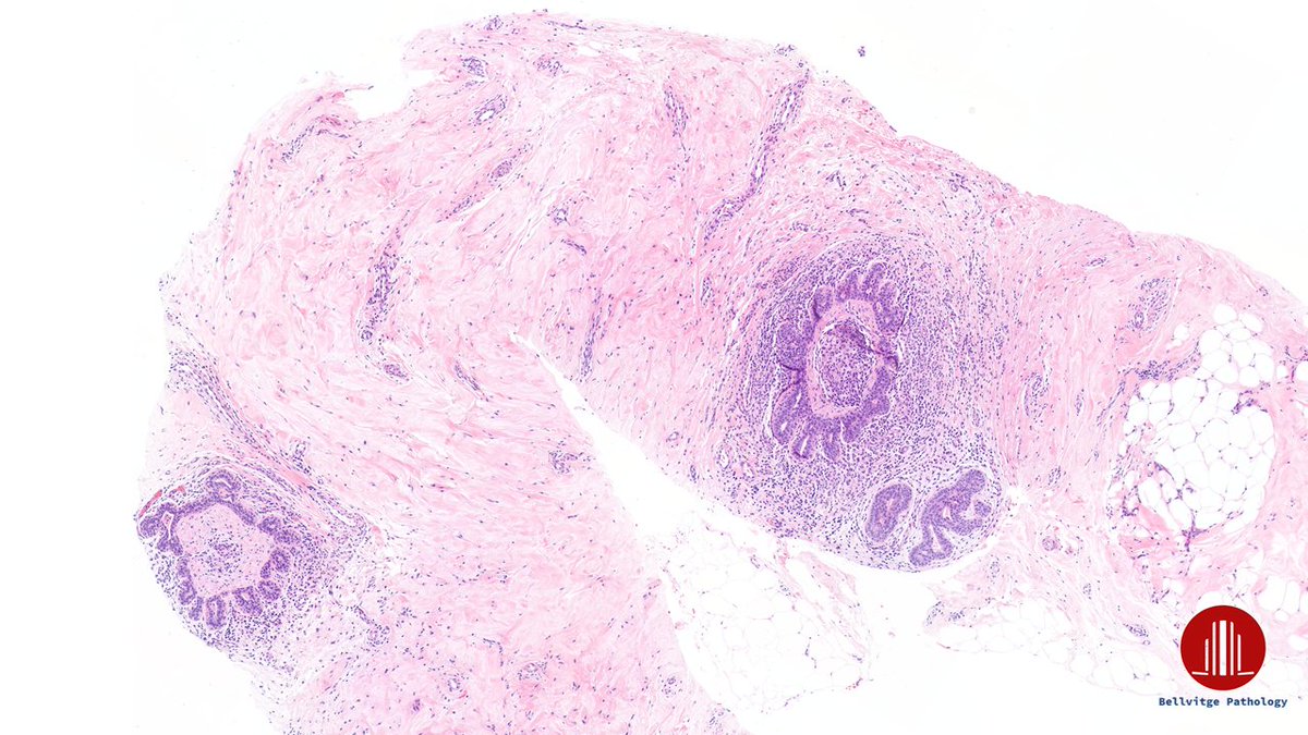 bellvitgepath's tweet image. Woman in her 50s. 
Left breast lesion, BI-RADS 4c.

#BreastPath #BellvitgePath