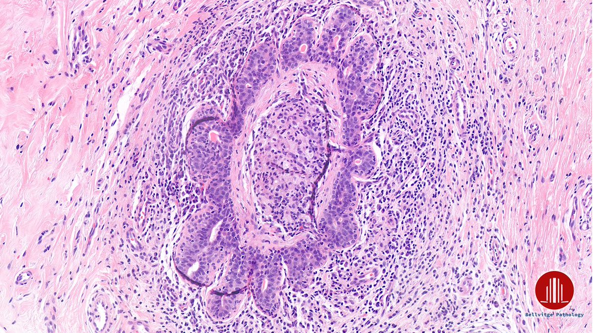 bellvitgepath's tweet image. Woman in her 50s. 
Left breast lesion, BI-RADS 4c.

#BreastPath #BellvitgePath