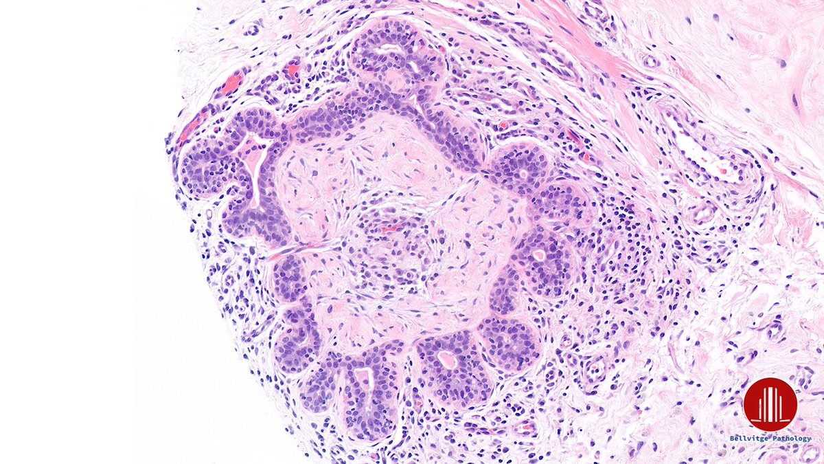 bellvitgepath's tweet image. Woman in her 50s. 
Left breast lesion, BI-RADS 4c.

#BreastPath #BellvitgePath
