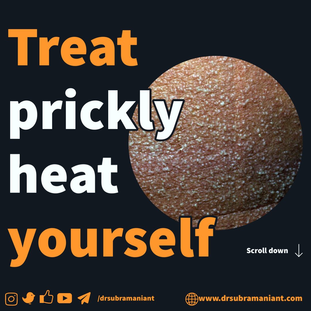 It’s summertime in India☀️🇮🇳. Scorching heat🔥 can produce heat rash (prickly heat).Know how to protect yourself👇🏾
#heatrash #pricklyheat #summertime #skincare #drst #dermatologist #salemtamilnadu