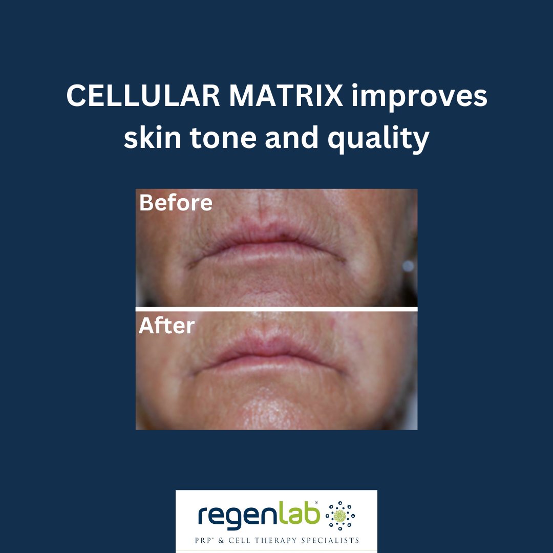 Regenlab_UK's tweet image. Significant improvement of the skin with Cellular Matrix treatment (CM-PRP-HA), including improvement in skin quality and tone and wrinkle depth after three treatment sessions.

#cellularmatrix #PRP #treatment #wrinkles #skin #skincare #skintreatment #skintone #aesthetics #clinic