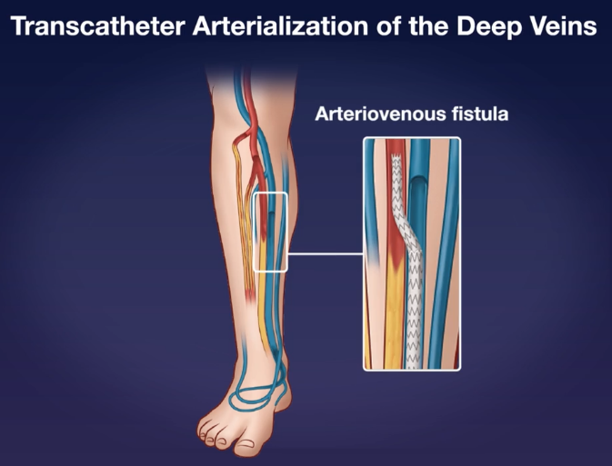 The future is now: transcatheter arterialization of deep veins proved successful in a single-arm study including 105 patients with chronic limb-threatening ischemia and no conventional surgical or endovascular revascularization treatment options! nejm.org/doi/full/10.10… @NEJM