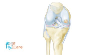 Hy2care starts with 2nd phase ACTIVE #clinicalstudy to improve #cartilagerepair in the knee. The Medical Ethical Review Committee of <a href="/UMCUtrecht/">UMC Utrecht</a> has granted approval to continue the study, which will be conducted by @UMC Utrecht <a href="/MaastrichtUMC/">Maastricht UMC+</a>, <a href="/ETZnl/">ETZ</a>: bit.ly/3lNvsFN